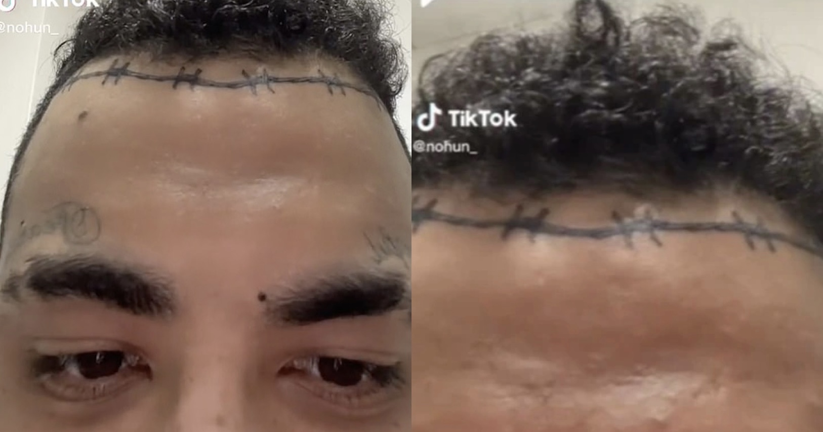30-vjeçari bën tatuazh një tel me gjemba, njerëzit mendojnë se ka mbjellë flokët