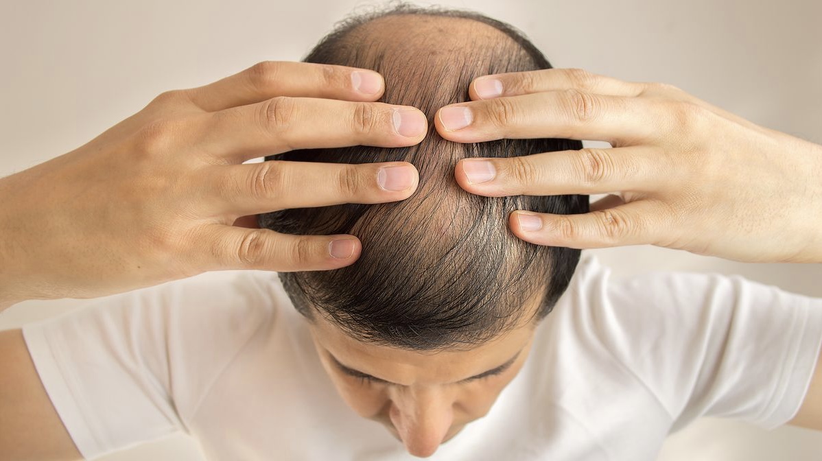 Studimi: Pijet energjike shkaktojnë rënie flokësh te burrat