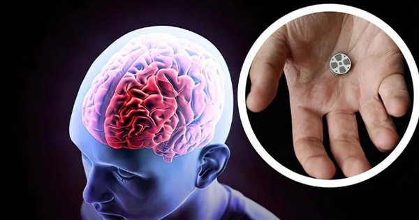 Implanti i parë në botë brenda trurit për të kuruar depresionin do të testohet për herë të dytë tek njeriu 