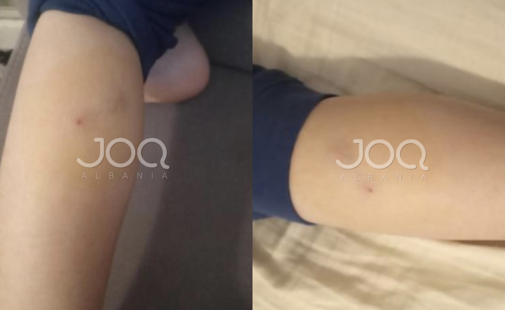 Qytetaren në Tiranë e kafshon qeni pa maskë: Bobo ku jetojmë, asnjë ligj!