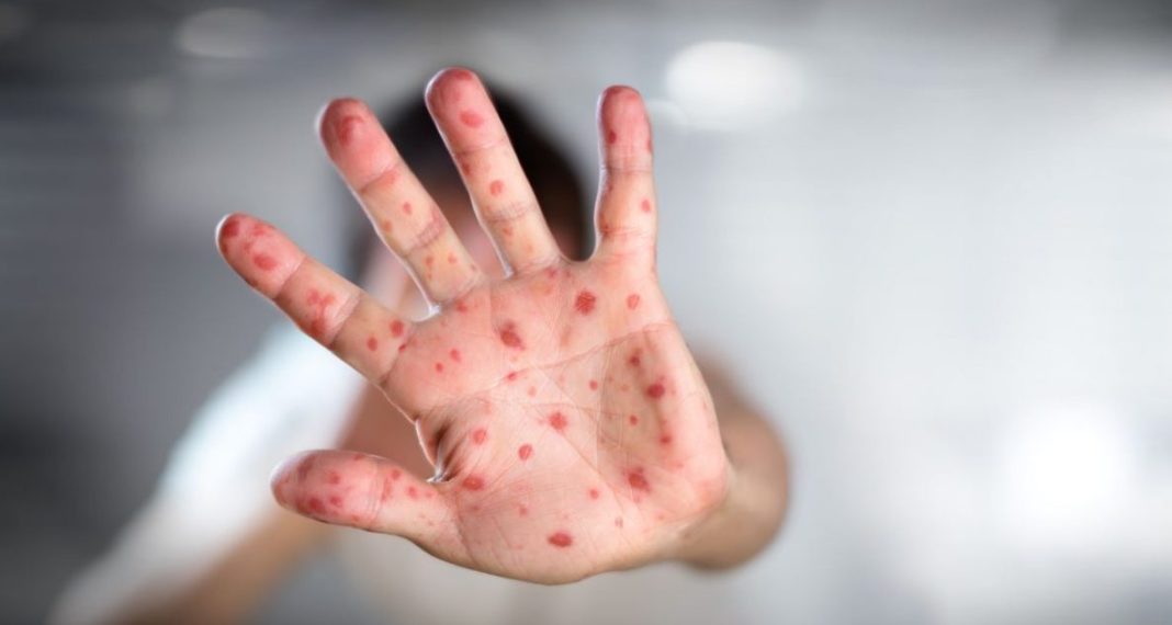 Kujdes, zhuga ka filluar të përhapet në Kosovë