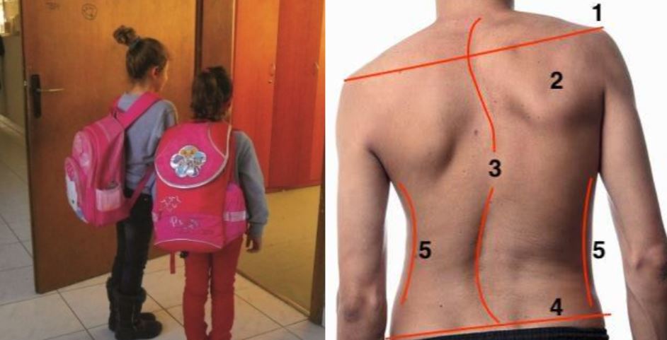 Çantat e shkollës po bëjnë fëmijët me skoliozë