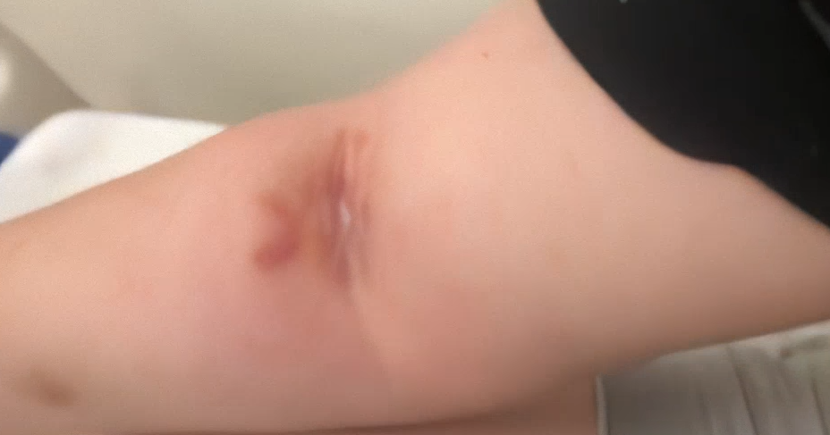 Qytetarja denoncon infermieren: Shkova të bëj serum dhe nuk po me gjente damarët, m’u ënjt krahu