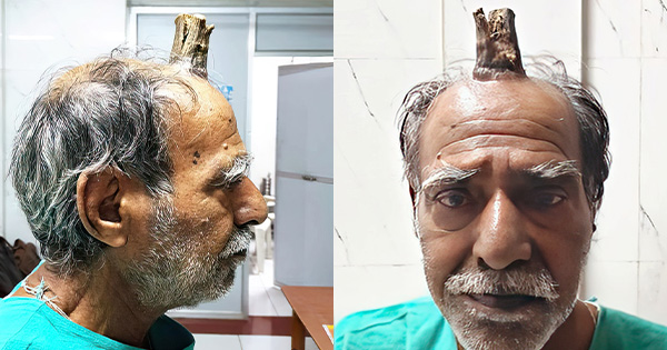 Burrit në Indi i del  briri i Djallit  në kokë  ia heqin mjekët