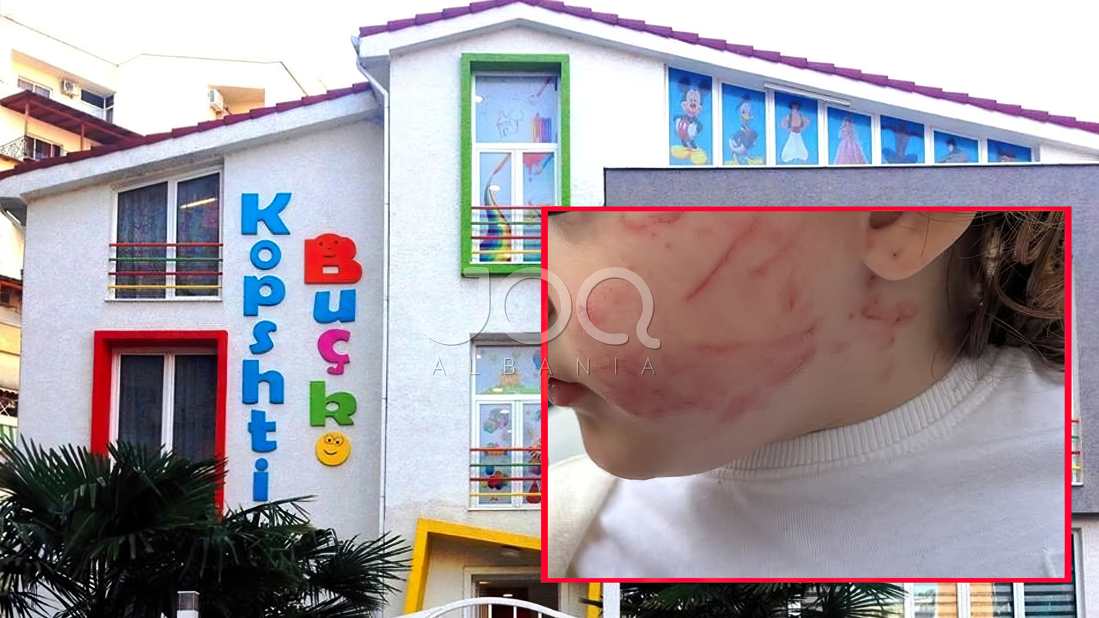 Skandal në kopshtin “BUÇKO” në Tiranë: Dhunë fizike ndaj fëmijës dhe fshehje e ngjarjes