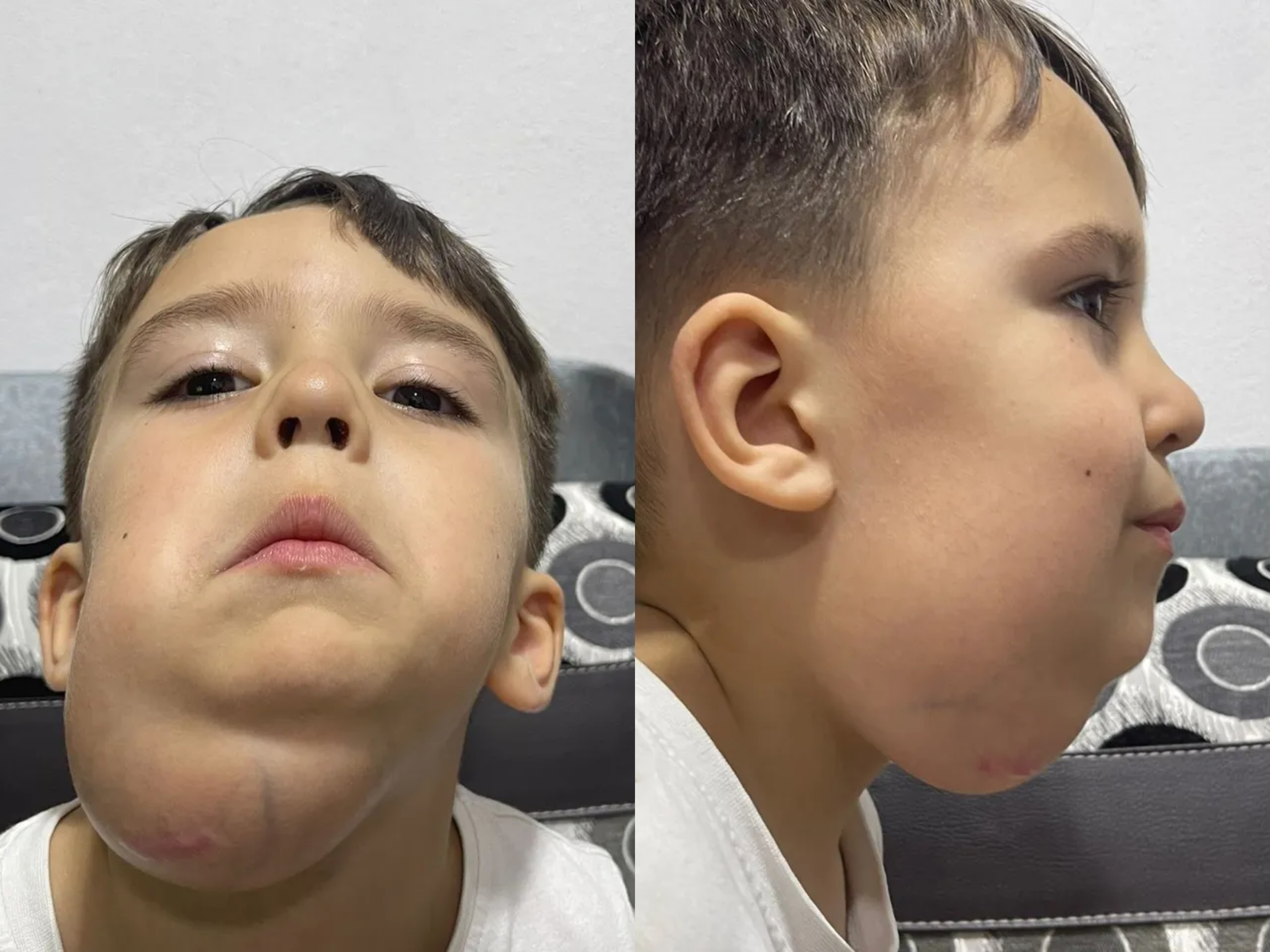 Po përballet me një tumor të rrallë, 3-vjeçari Kisman ka nevojë urgjente për ndihmë