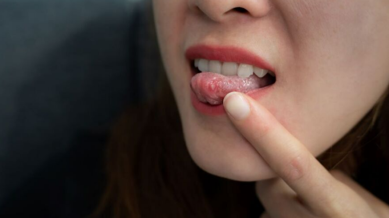 Ulçera që nuk largohet? Ekspertët paralajmërojnë çfarë të bëni