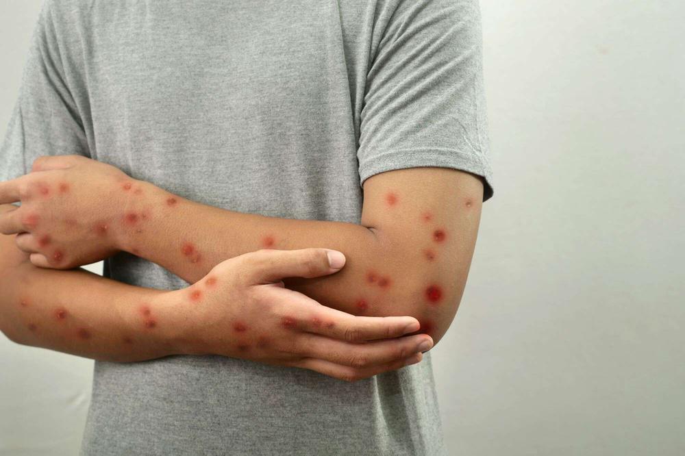 Regjistrohet vdekja e parë për shkak të epidemisë së mpox-it