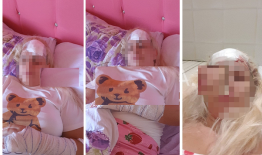 Vajza nga Vushtrria publikon pamje tronditëse të lëndimeve që ia shkaktoi babai: Më goditi me çekan në kokë