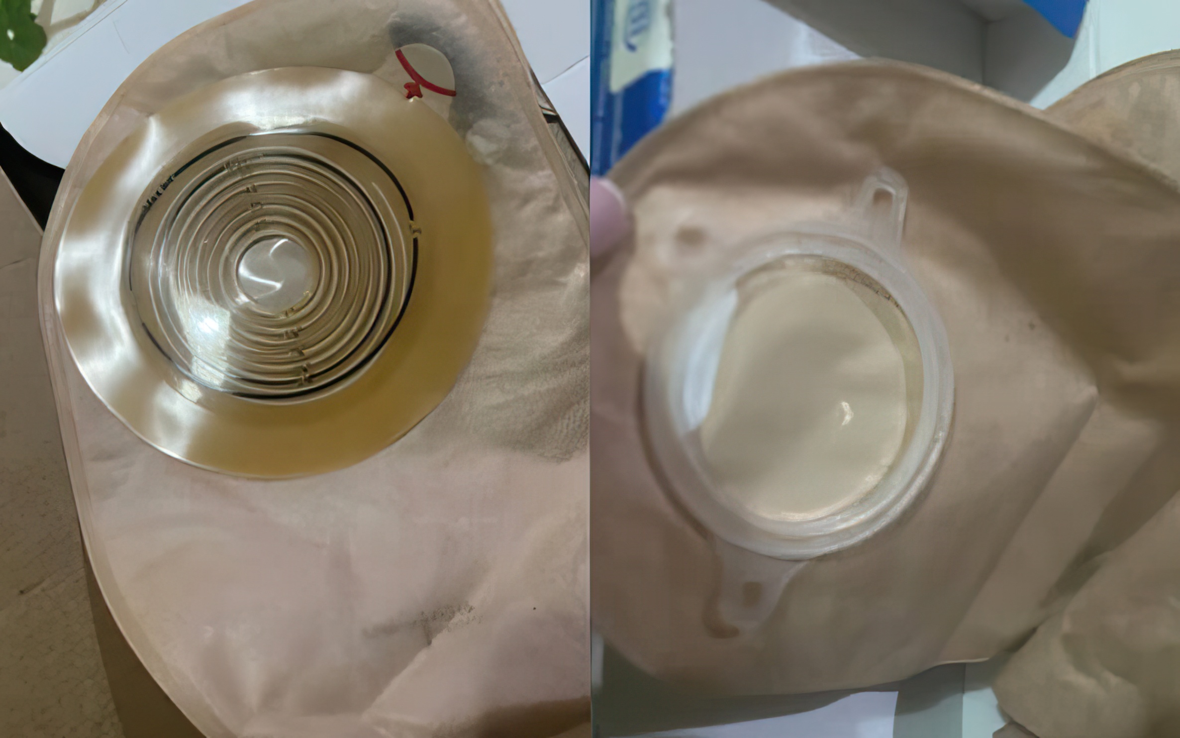 Pas betejës së babit të saj me tumorin në zorrën e trashë, qytetarja nga Fieri dhuron qese kolostomie për personat në nevojë