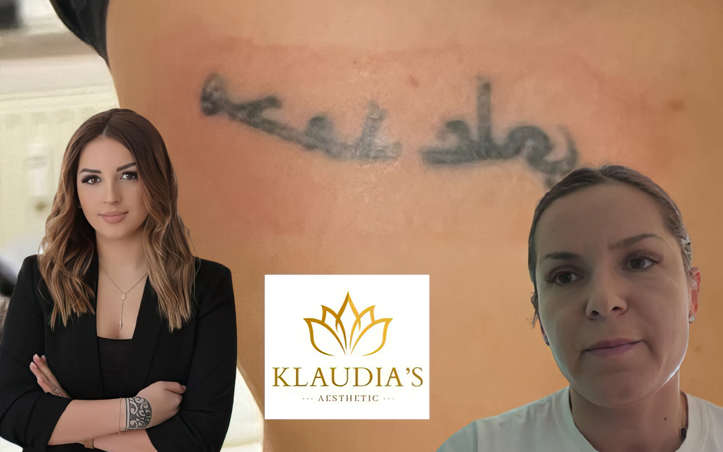 Qytetarja shkon te “klaudias_aesthetic” për heqje tatuazhi, përfundon me djegie dhe pa rezultat