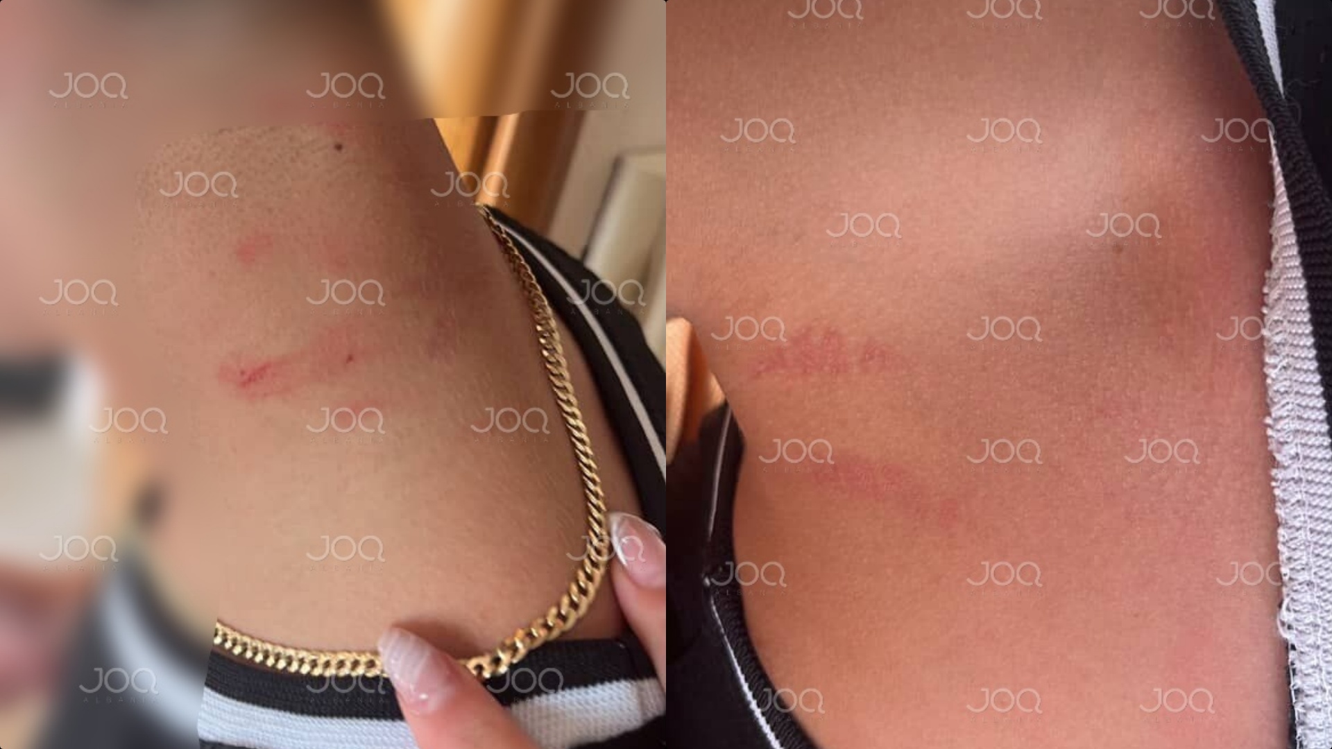 ‘Banda e 15-vjeçarëve’ bën kërdinë në Pogradec, të riut i ‘çanë’ lëkurën për t’i marrë varsen