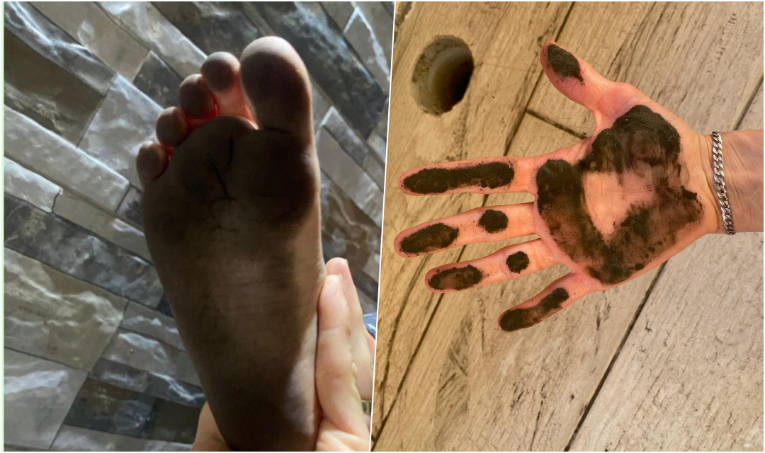 “Porti i Durrësit po na mbyt me pluhur qymyri, motra e vogël është shtruar 3 herë në spital për bllokim të mushkërive”