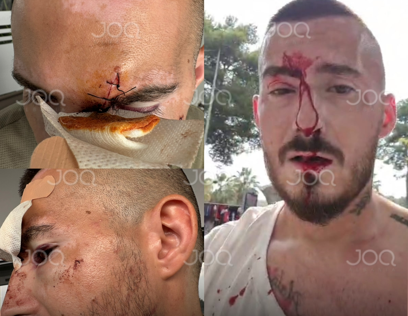 EKSKLUZIVE/ Austriaku denoncon skandalin në JOQ: Më futën kaçavidën në ballë, policia më përcolli!