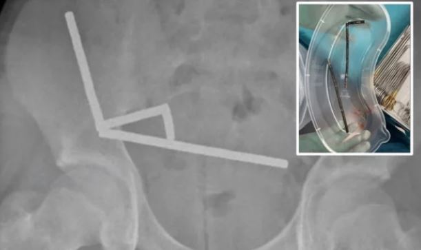 Adoleshenti gëlltiti 200 magnete, kirurgët i hoqën pjesë të zorrëve për t’ia shpëtuar jetën