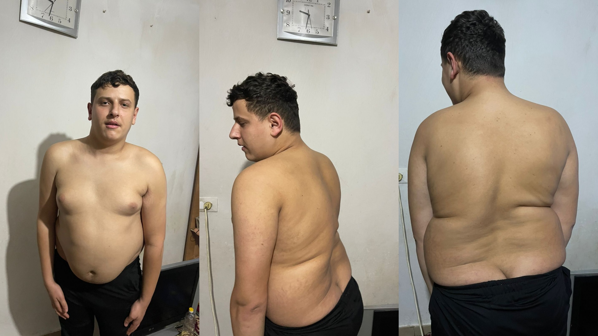 Emrah kërkon ndihmë për operimin e shtyllës kurrizore