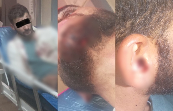 Policia greke dhunon të riun shqiptar, ndodhet në gjendje të rëndë në spital