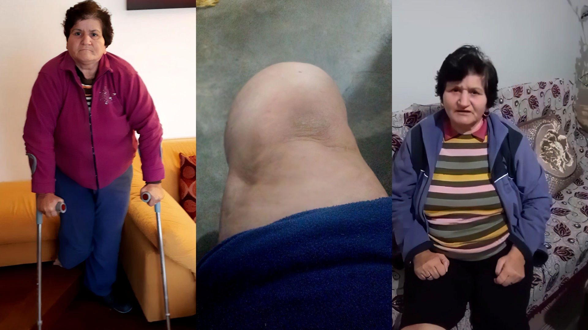 Nënë Liria u kërkon shqiptarëve një protezë për këmbën e saj