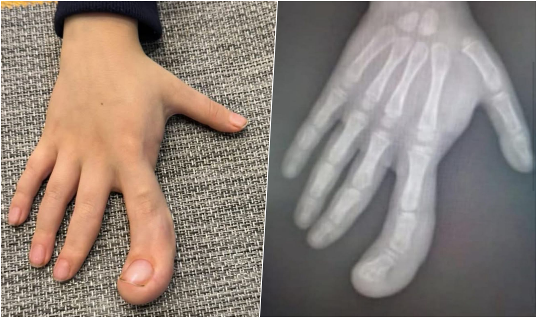 Vuan nga një problem serioz në dorë  vogëlushi 6 vjeçar ka nevojë urgjente për ndihmë