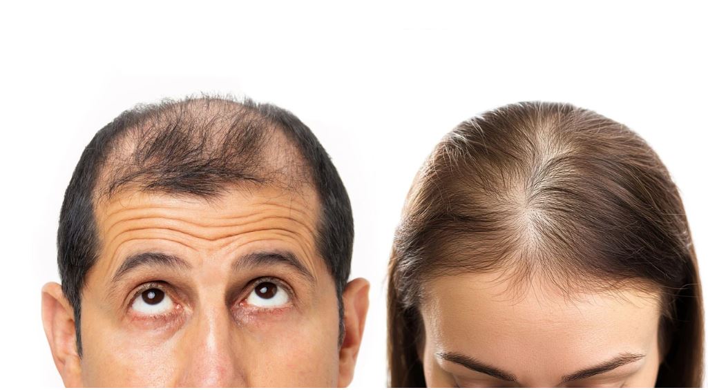 Pse bien flokët pikërisht në pjesën e përparme të kokës? Ja çfarë thonë studimet