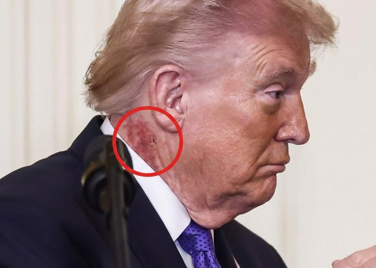 Shenja në qafë të Trumpit trondit rrjetin, reagon Shtëpia e Bardhë