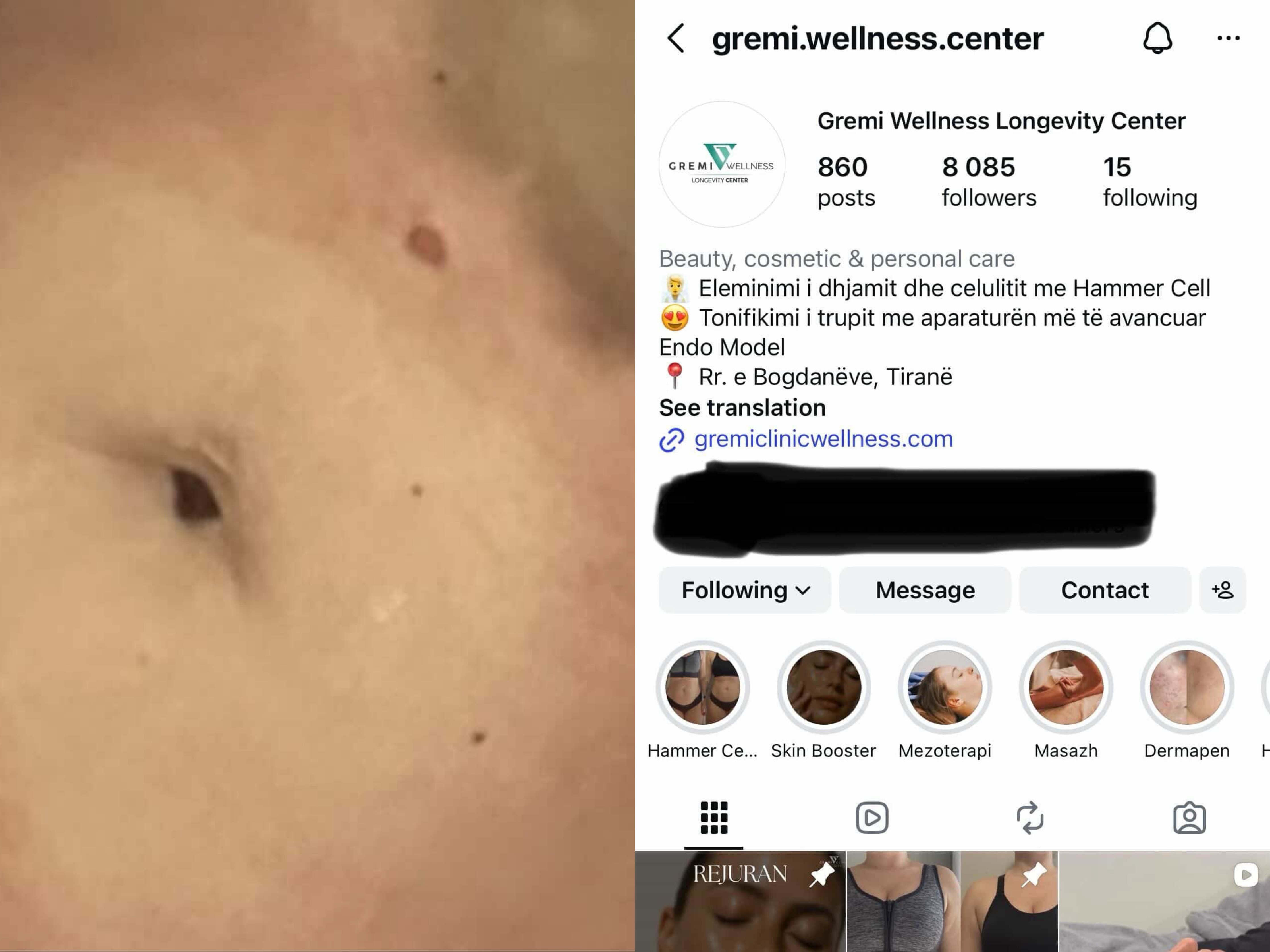 “Te Gremi Center estetistja edhe recepsioniste: Më dogjën barkun dhe s’mbajnë përgjegjësi”