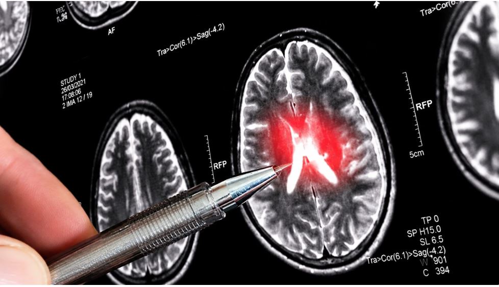 Tumori i trurit tani mund të zbulohet për 12 minuta: AI sjell kthesë në neuroonkologji