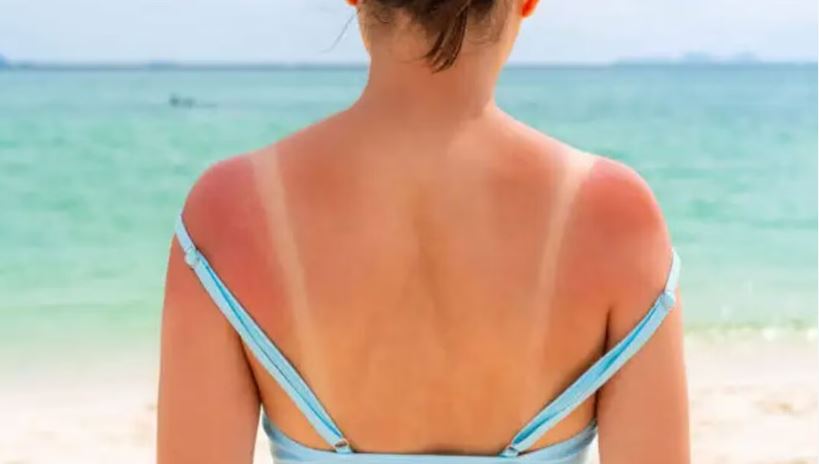 Si ta lehtësoni menjëherë djegien nga dielli me aloe vera