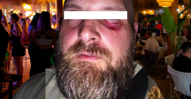 “Turisti shqiptaro-gjerman dhunohet nga 7 kamarier në Golem, policia nuk erdhi”