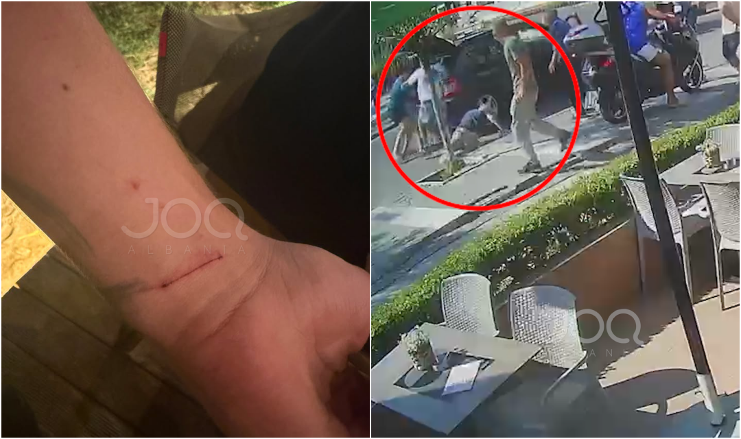  E goditën me sëpatë   familja denoncon konfliktin  15 vjeçari përfundoi i plagosur