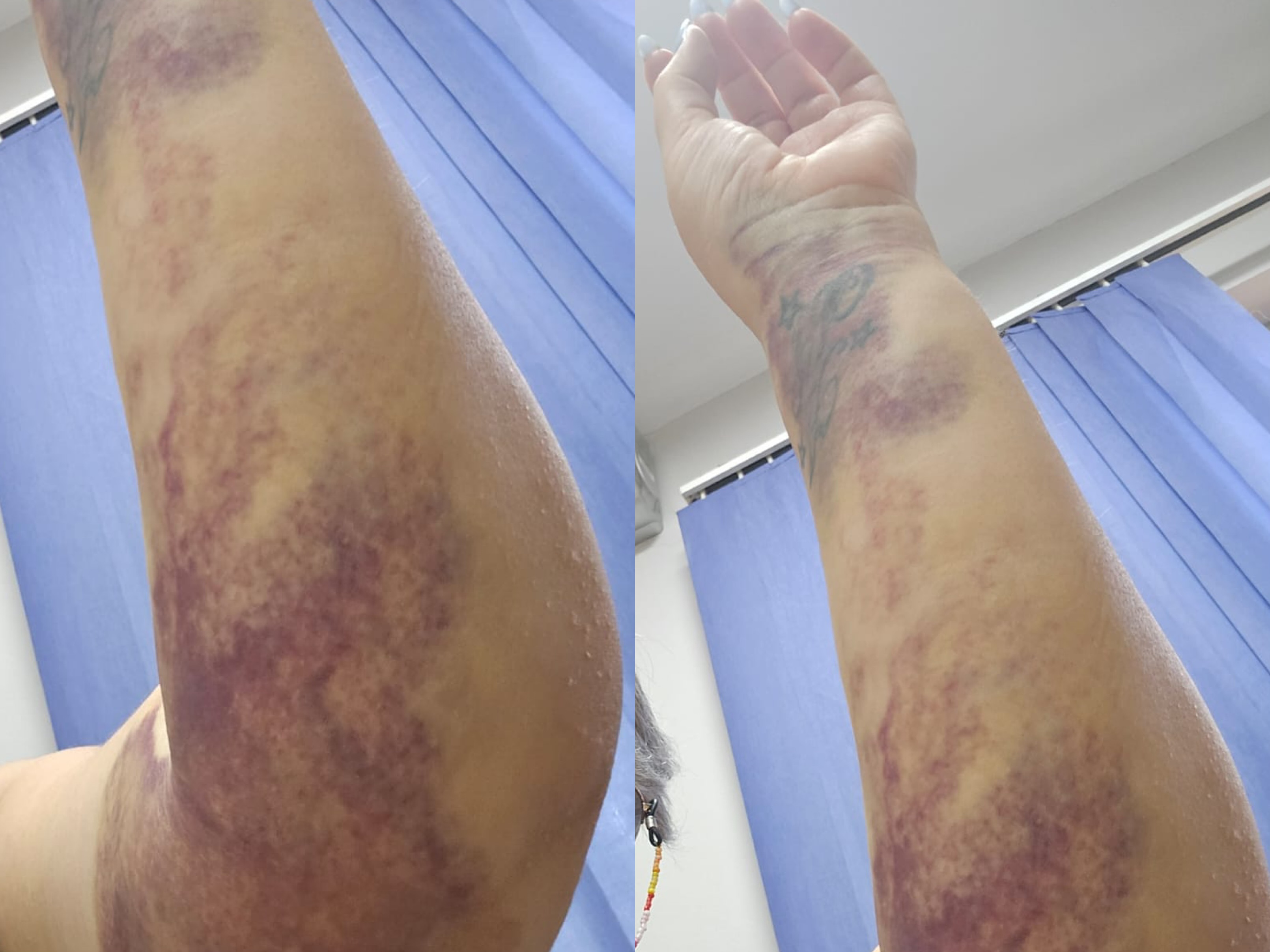“Kam dhimbje dhe krahun e nxirë, mjeku te Trauma më tha ‘hajde nesër’ se s’je rrëzuar sot”