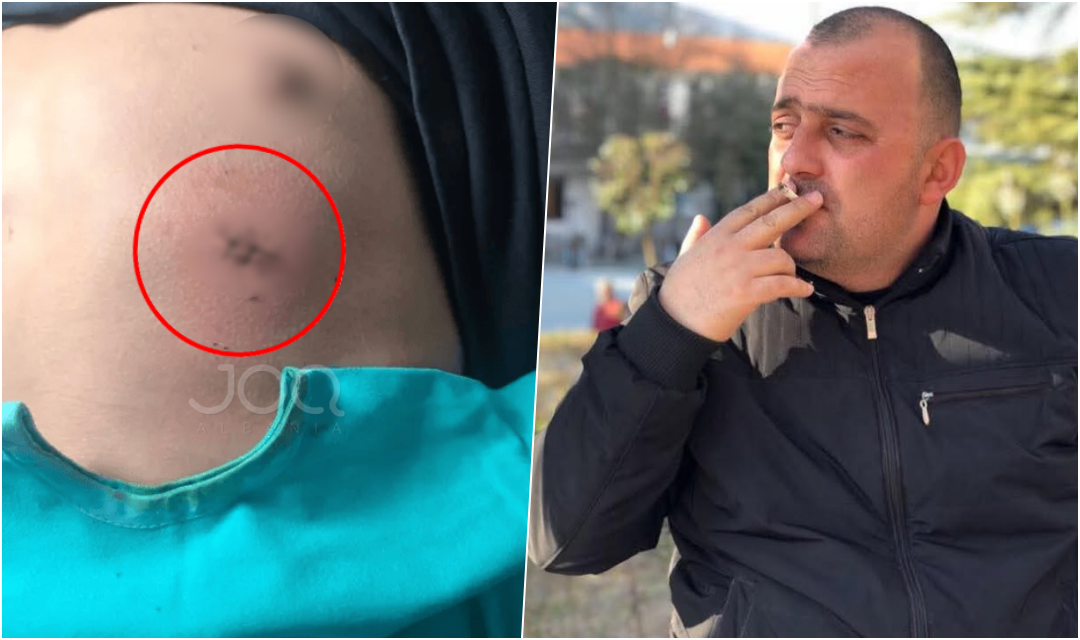 Dhuna në Gramsh, pala tjetër: Loli Çoku goditi me thikë në kraharor djalin e Almir Çekrezit!