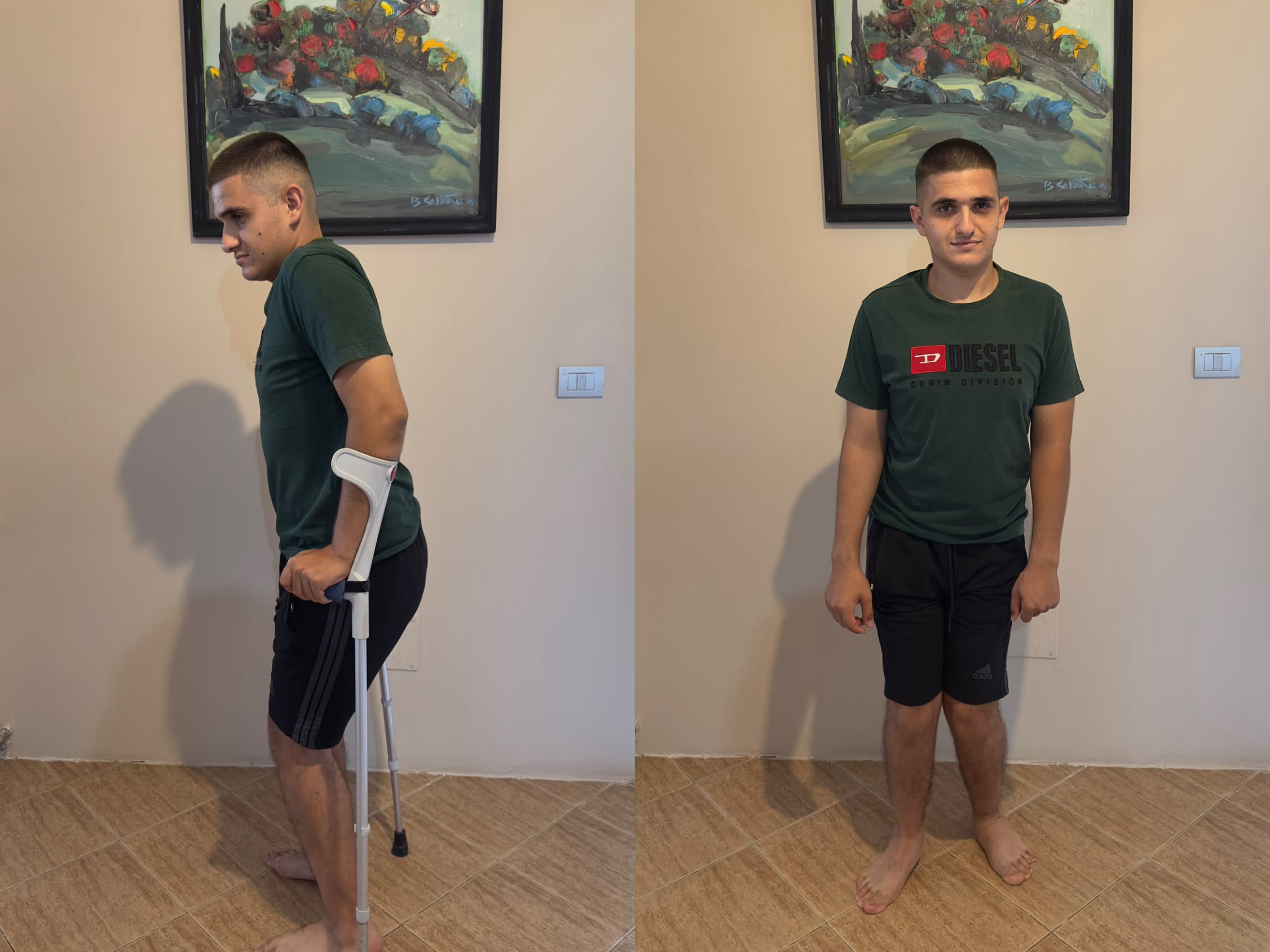 Që prej moshës 1-vjeçare me paralizë cerebrale, operacioni në Gjermani mund t’i ndryshojë jetën Vilsonit